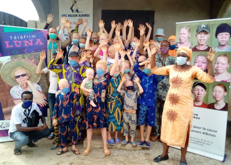 Célébration de la Journée Internationale de l’Albinisme, édition 2020: l’ONG Valeurs Albinos offre  des kits alimentaires aux Albinos.
