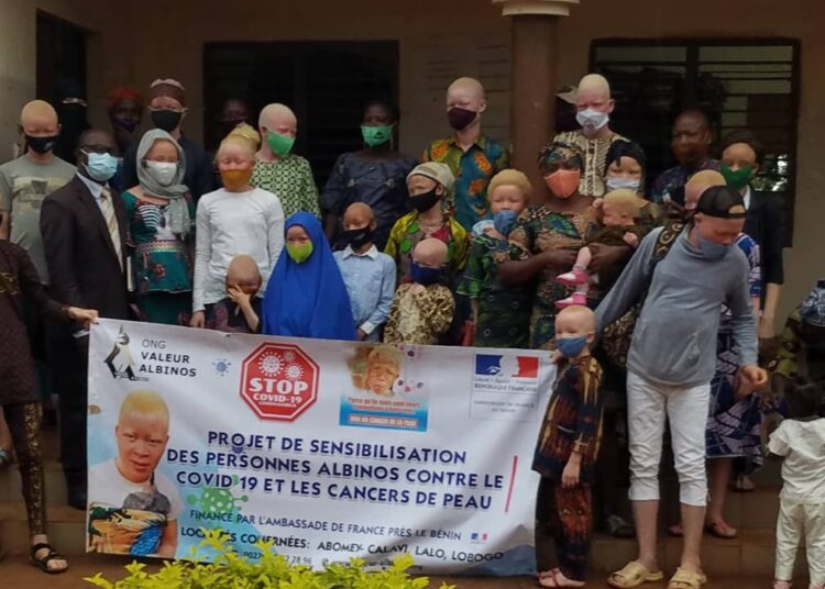 Lutte contre le Covid 19 : l’ONG « VALEUR ALBINOS » offre des kits aux personnes Albinos.