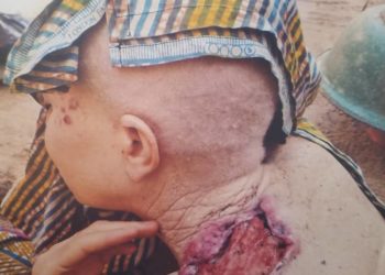 Droits de l’homme : L’ONG Valeur Albinos lance le téléthon « Albi sans cancer » pour le bien être des personnes Albinos.